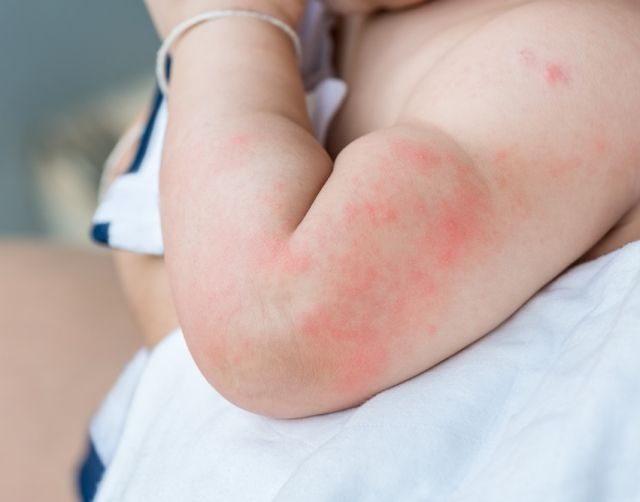 Аллергия на слайм у ребенка